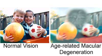 Age-related Macular Degeneration