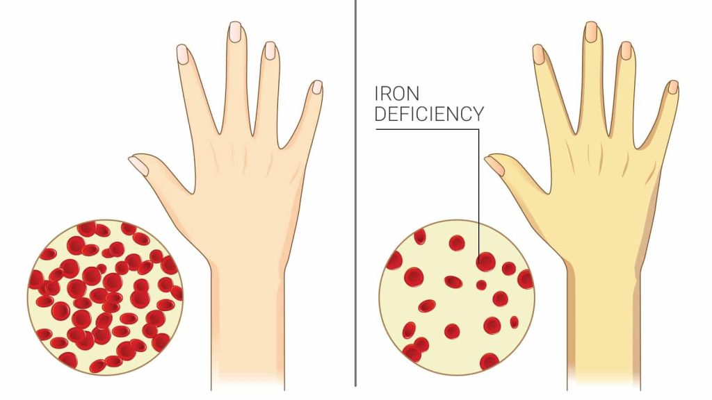 Could Your Genes Be The Cause Of Iron Deficiency Advanx Health Blog 2655