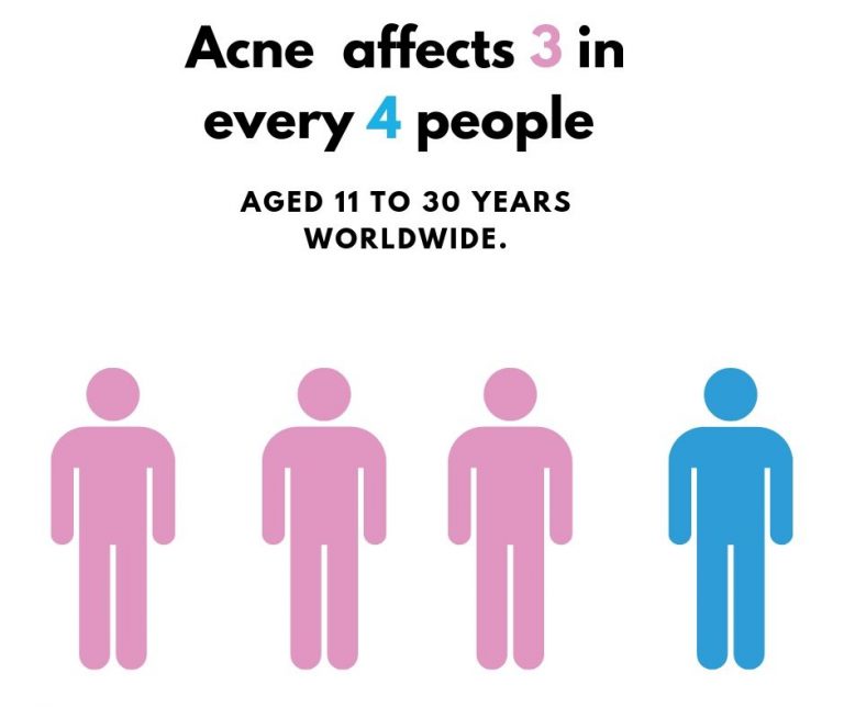 Acne Affects 3 In Every 4 People A 768x644 