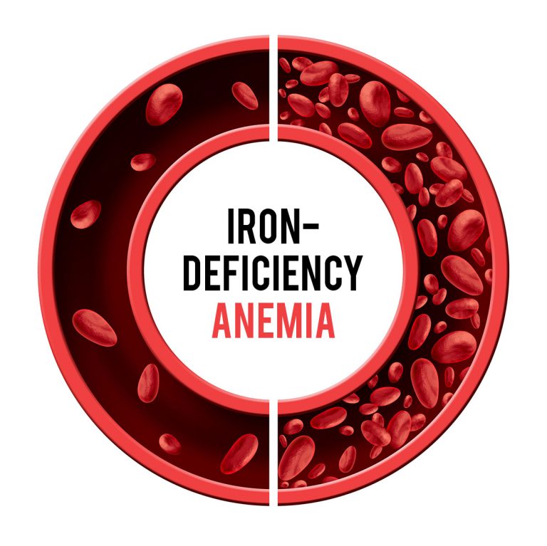 Could Your Genes Be The Cause Of Iron Deficiency Advanx Health Blog