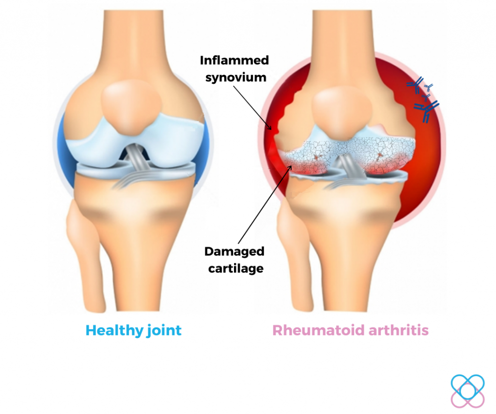 Rheumatoid Arthritis- Autoimmune disorder