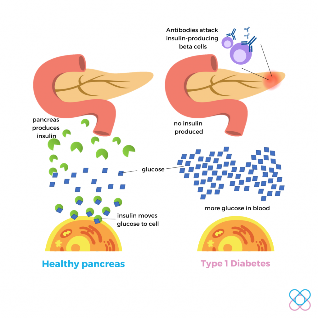 Type 1diabetes- Autoimmune Disorder