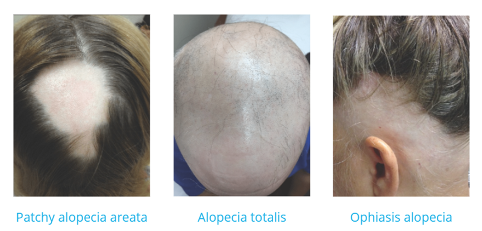 Alopecia areata, types, patchy, totalis, ophiasis, hair loss