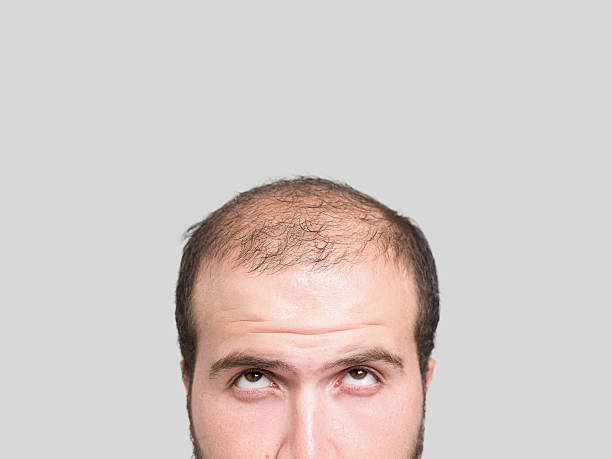 A balding man 